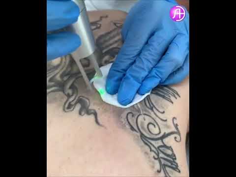 Удаление татуажа бровей лазером: как правильно свести и затем восстановить кожу