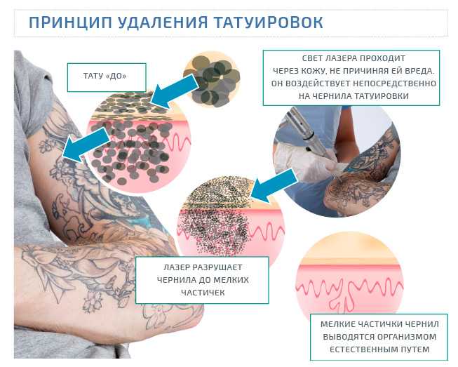 Лазерное удаление татуажа: стоит ли рисковать (2021)