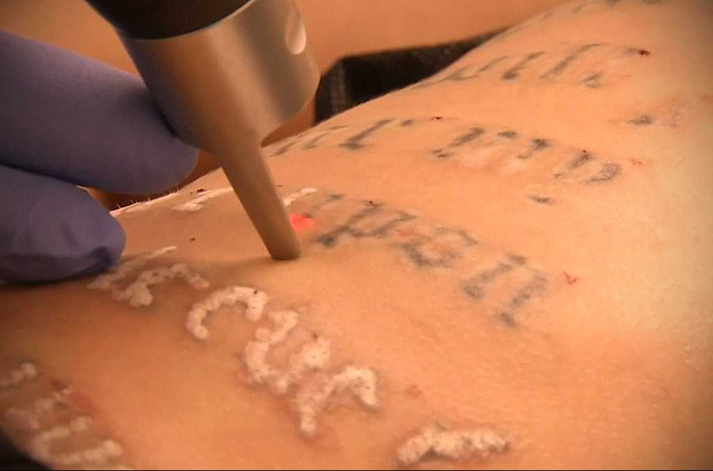 Вредно ли для зрения и кожи век лазерное удаление татуажа?