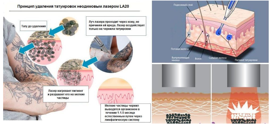 Лазерная блефаропластика без операции