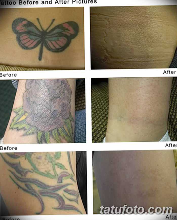 Удаление татуажа глаз лазером с век. фото до и после, отзывы, последствия, противопоказания