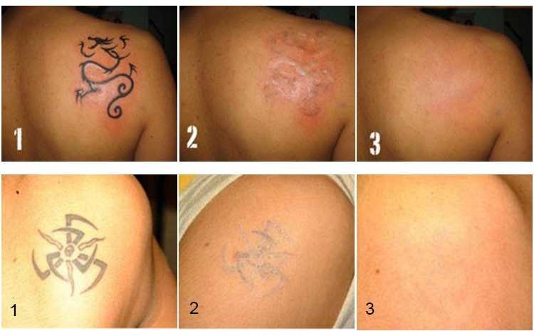 Удаление татуировок: методы, особенности, описание процедуры и последствий